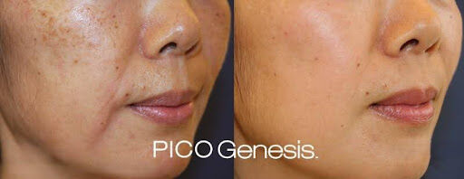 The Benefits of Pico Genesis for Skin Rejuvenation